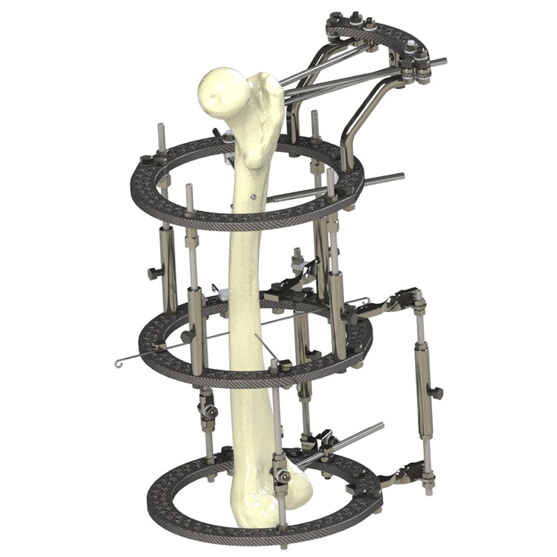 ILIZAROV external fixation system
