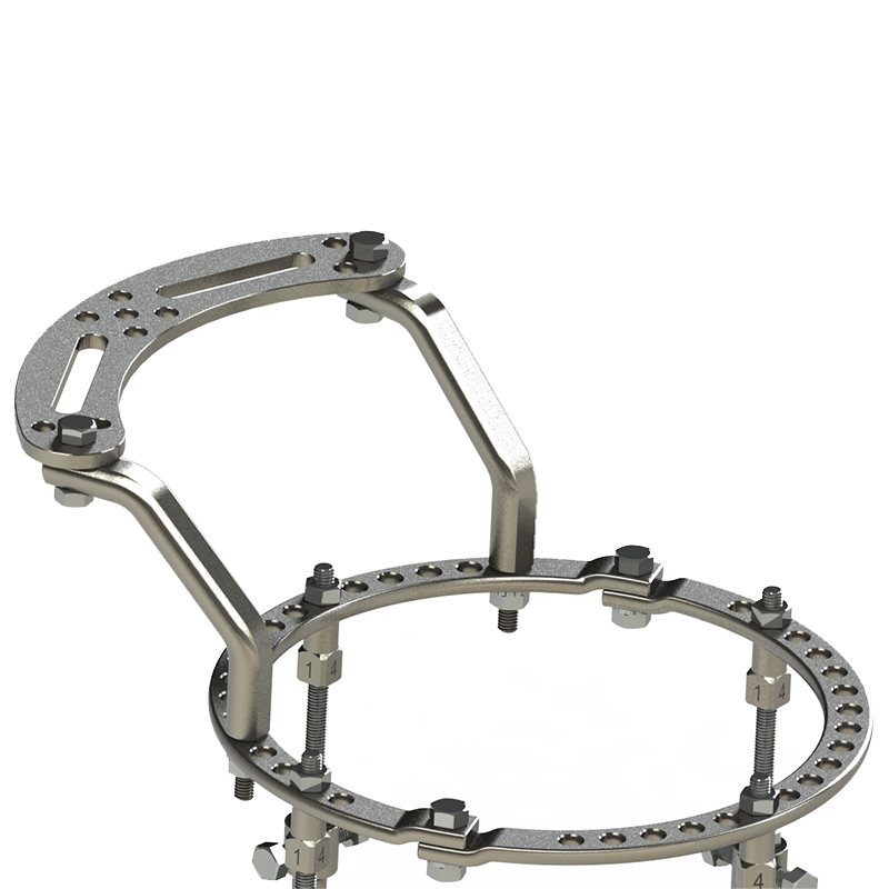 Sistema de Fixação Externo ILIZAROV